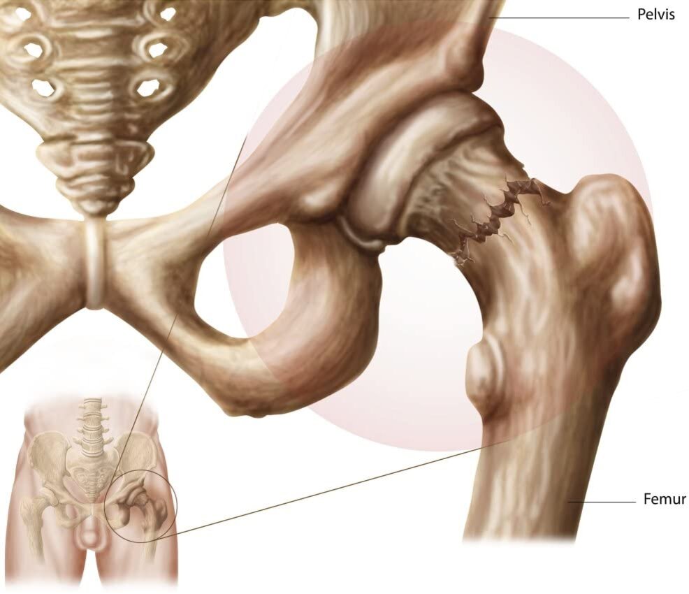 Скелет человека анатомия шейка бедра. Перелом анатомической шейки бедра. Тазобедренная кость скелет.