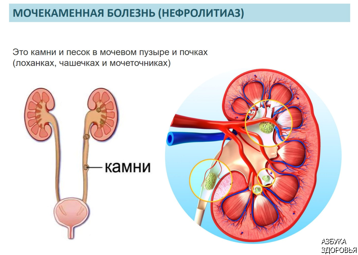 Болят почки после удаления камня