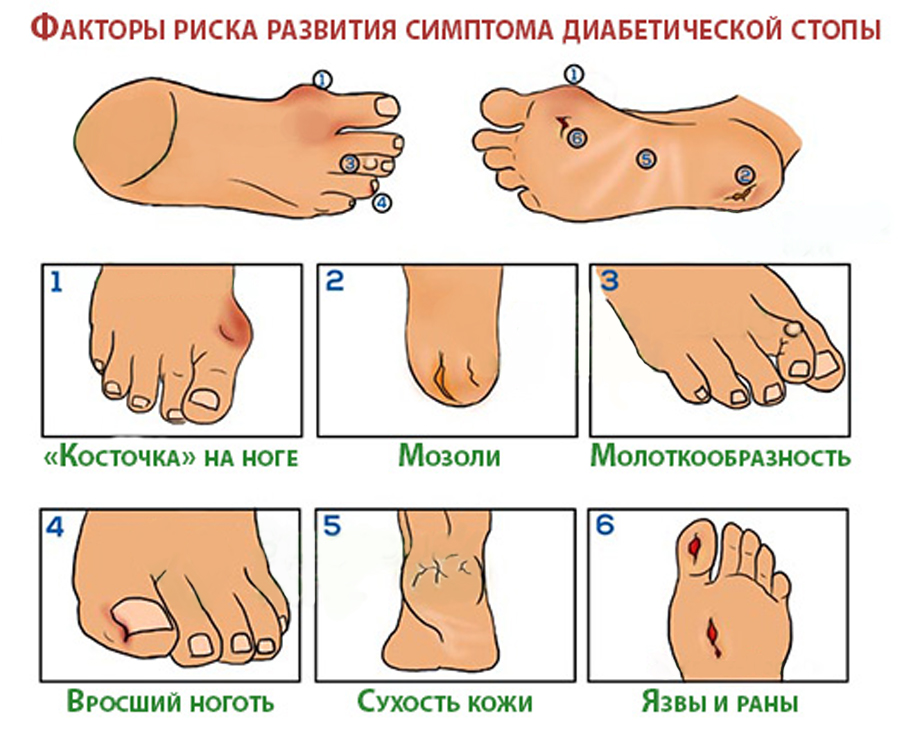 Признаки носи. Факторы риска развития синдрома диабетической стопы. Нейропатическая диабетическая стопа. Диабетическая стопа при сахарном диабете. Профилактика синдрома диабетической стопы.