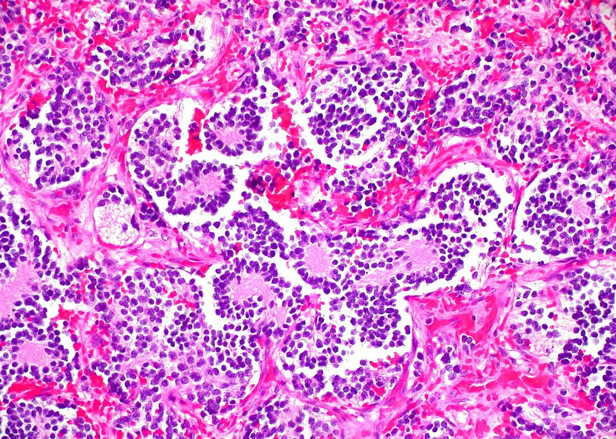 Нейробластома надпочечника под микроскопом. Источник: https://commons.wikimedia.org/wiki/File:Neuroblastoma_of_the_Adrenal_Gland_%281%29_%282274260199%29.jpg