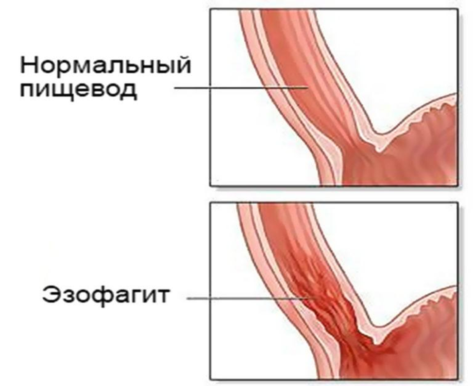 Чем лечат трофические язвы желудка народными средствами самые эффективные - фото