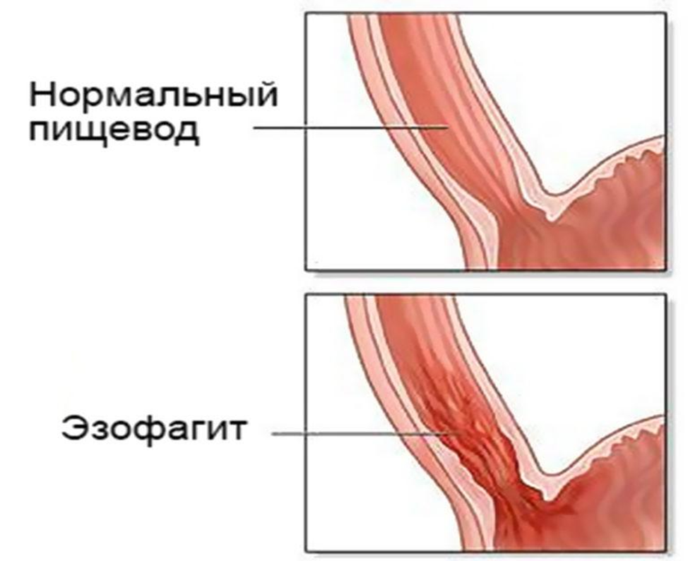 Выброс из желудка в пищевод. Дистальный катаральный рефлюкс-эзофагит. Рефлюксэзофагит дисталтный каторальный. Хронический рефлюкс эзофагит. Катаральный фибринозный рефлюкс эзофагит.