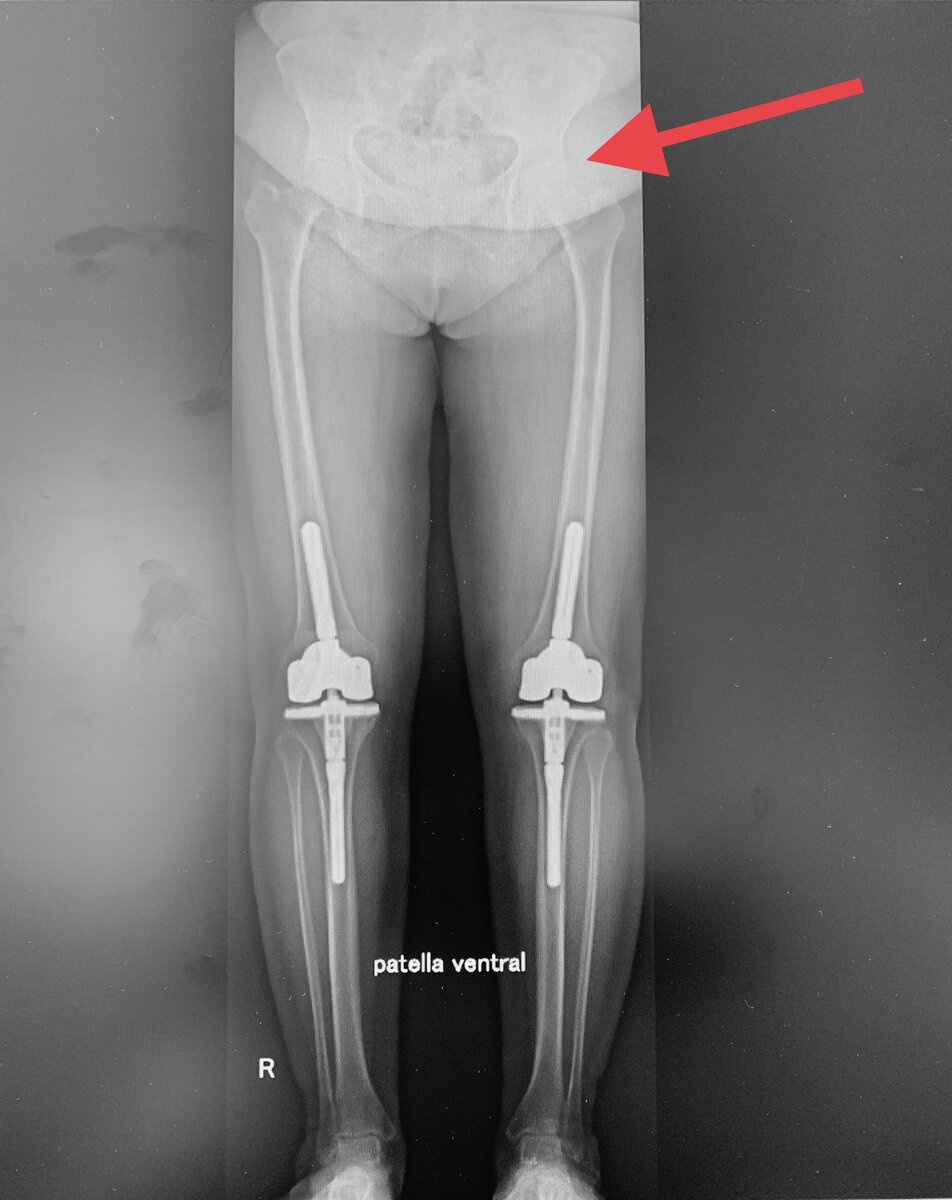 Стрелкой показан разрушенный тазобедренный сустав