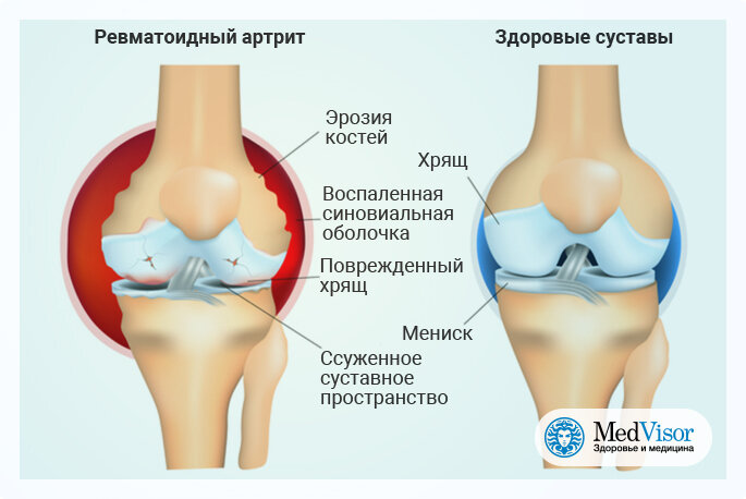 Сахарный диабет