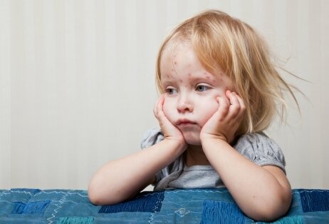    Основной и самый болезненный симптом ветрянки у детей — это красная, постоянно зудящая сыпь, которая чем-то напоминает последствия укусов насекомых