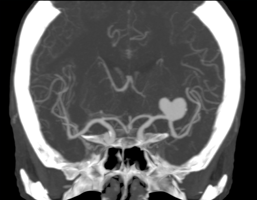 На этой КТ-ангиографии выявлена огромная аневризма одного из сосудов - похожа на сердечко.