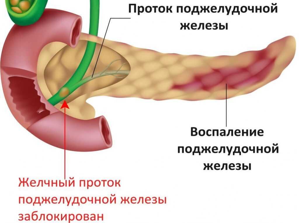 Поджелудочная железа какие симптомы. Обтурация протока поджелудочной железы. Хронический обструктивный панкреатит. Панкреатин поджелудочная железа. Кистофиброз поджелудочной железы.