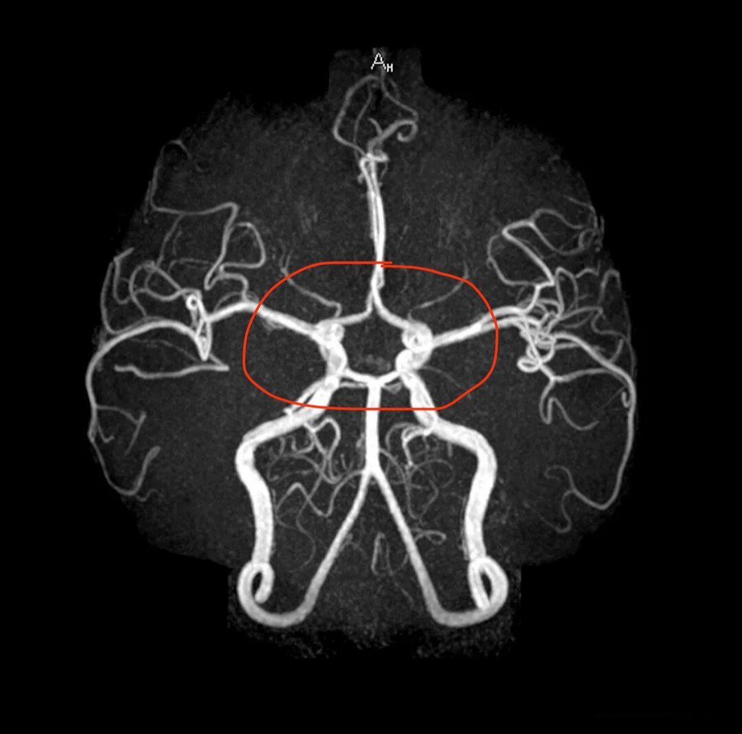 Мрт сосудов головы. МРА (магнитно-резонансная ангиография). Кт ангиография артерий головного мозга. Виллизиев круг мрт. Ангиограмма сосудов головного мозга.
