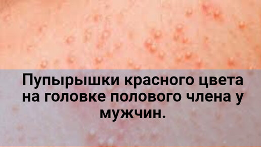 Пупырышки красного цвета на головке полового члена. | Гесклиник | Дзен