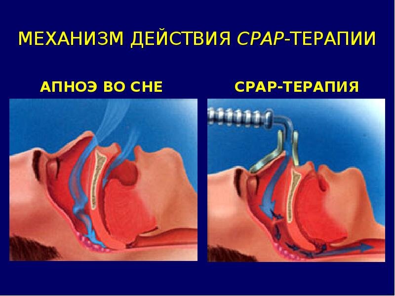 Здесь изображено, как именно действует респираторная поддержка при обструктивном апноэ сна - создается "воздушная подушка", поддерживающая дыхательные пути в расправленном состоянии