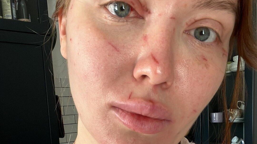     Красноярский врач-косметолог Антонина Мнева рассказала, что на нее напала консьержка ее дома и пыталась выдавить ей глаза «за дочь».