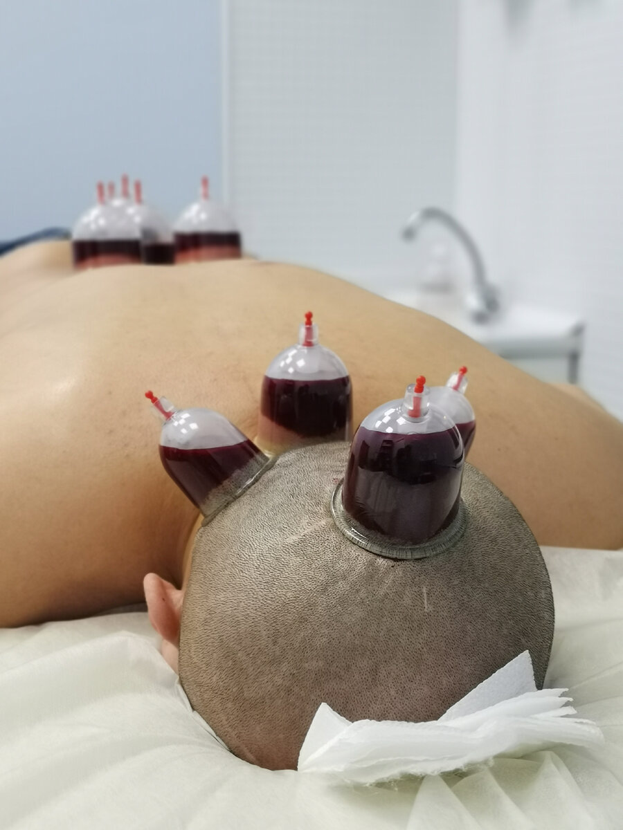 Хиджама на голову.