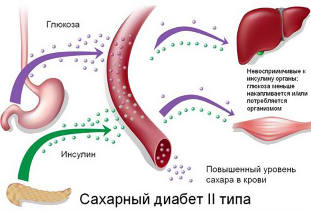 Диабет 3 типа