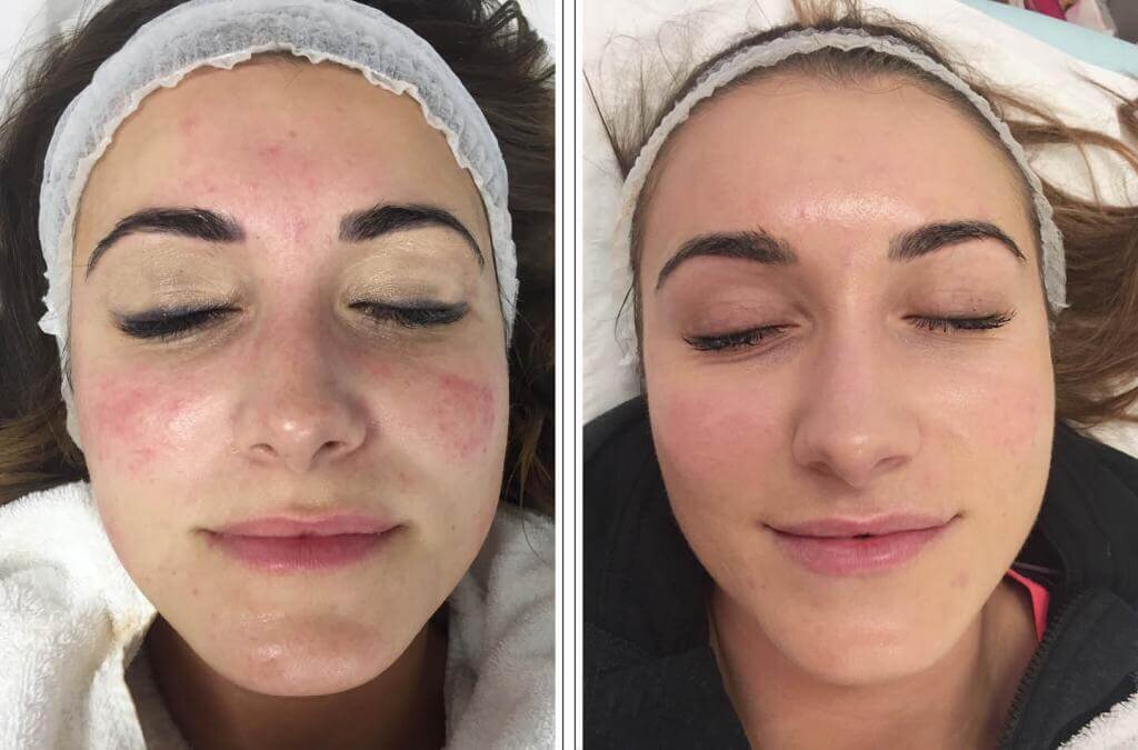 Пилинг лица в домашних условиях ✨ | Beauty Patches 🐼