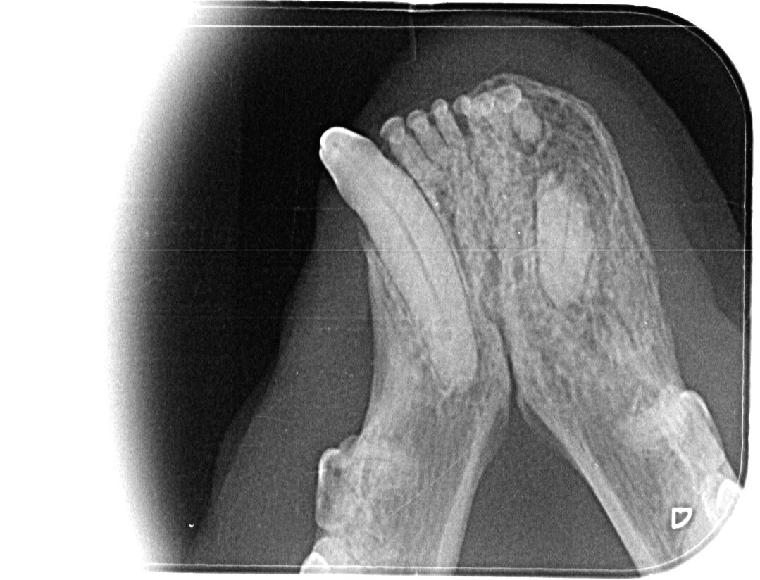 Рентген нижней челюсти. Справа видно, что зуб сломан, а корень остался внутри