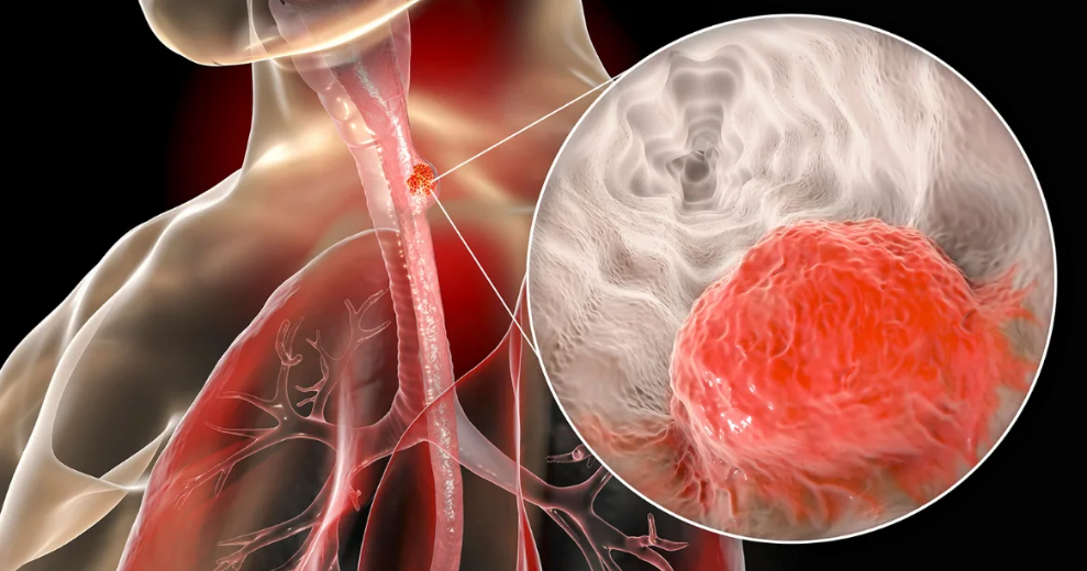 Рак пищевода картинки