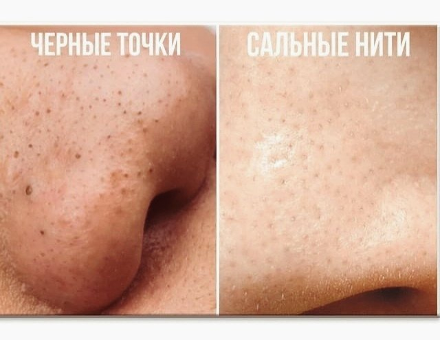 Чёрные точки и сальные нити: что это такое и как от них избавиться ...