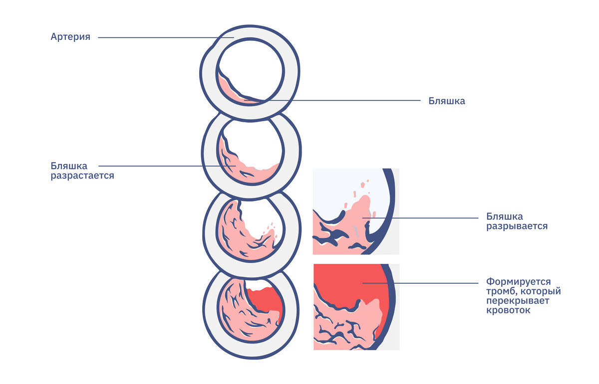 Подпись: Бляшка на стенке сосуда растет и закупоривает его. Она может лопнуть, и получится тромб. Тогда путь крови к сердцу будет перекрыт.

Источник: mayoclinic.org