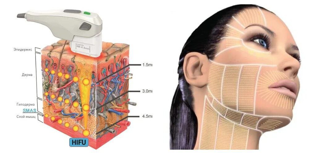 Смас лифтинг (аппарат hifu). В чем польза для клиента и косметолога ...