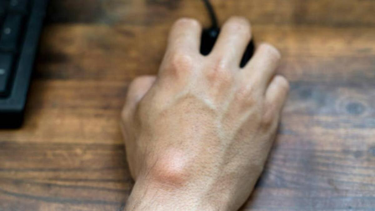   Липома на кисти руки:iStockPhoto