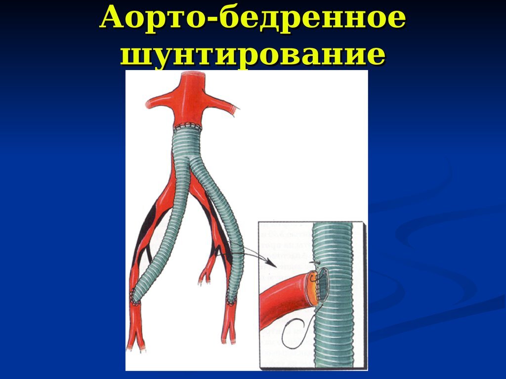 Протезирование сосудов презентация