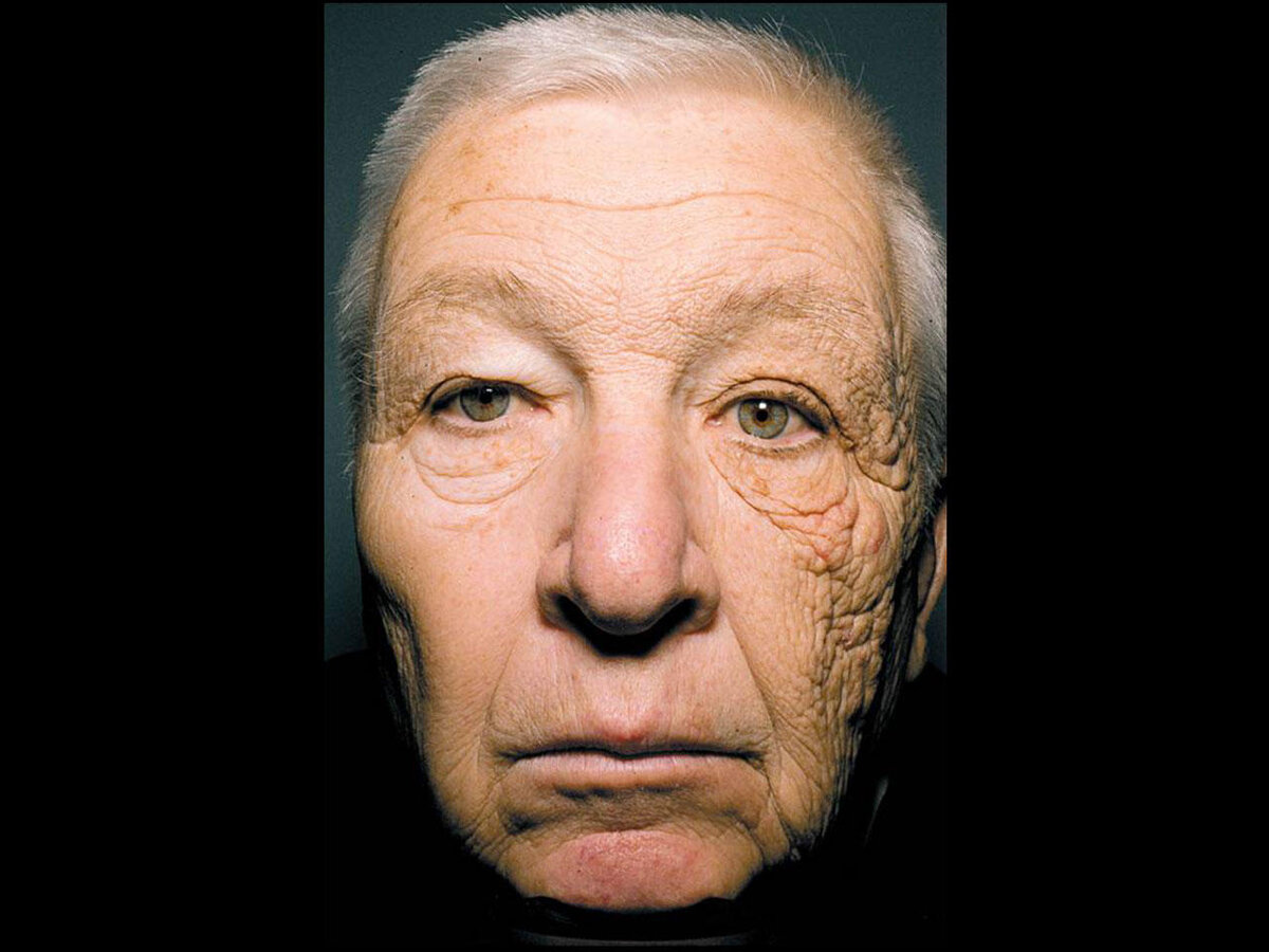Источник фото https://www.cbsnews.com/news/trucker-accumulates-skin-damage-on-left-side-of-his-face-after-28-years-on-the-road/