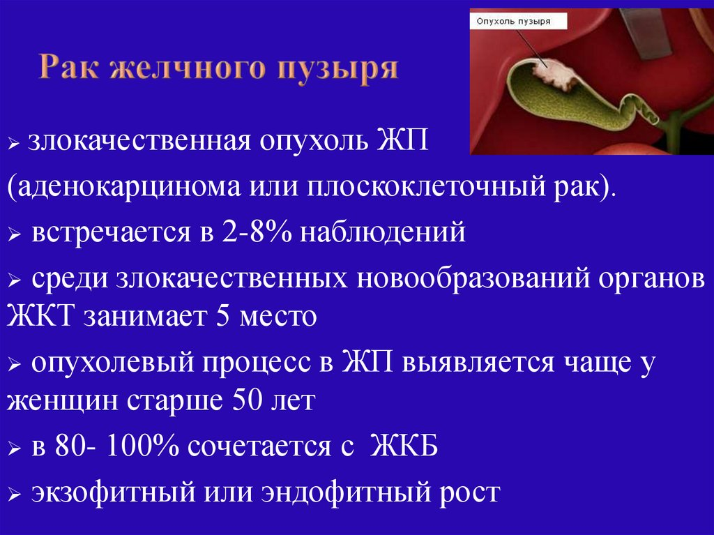 Отек желчного пузыря. Новообразование желчного пузыря. Злокачественная опухоль желчного пузыря. Карцинома желчного пузыря. Неоплазия желчного пузыря.