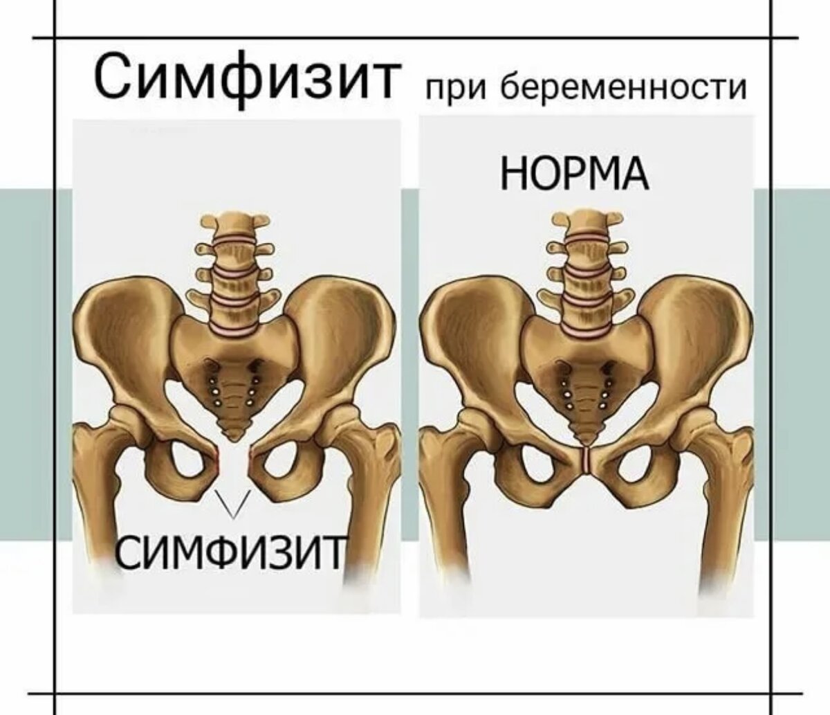 Кости роды. Норма расхождения симфизита. Расхождение костей лонного сочленения при беременности. Симфизит тазобедренного сустава. Симфизит расхождение лонного сочленения.