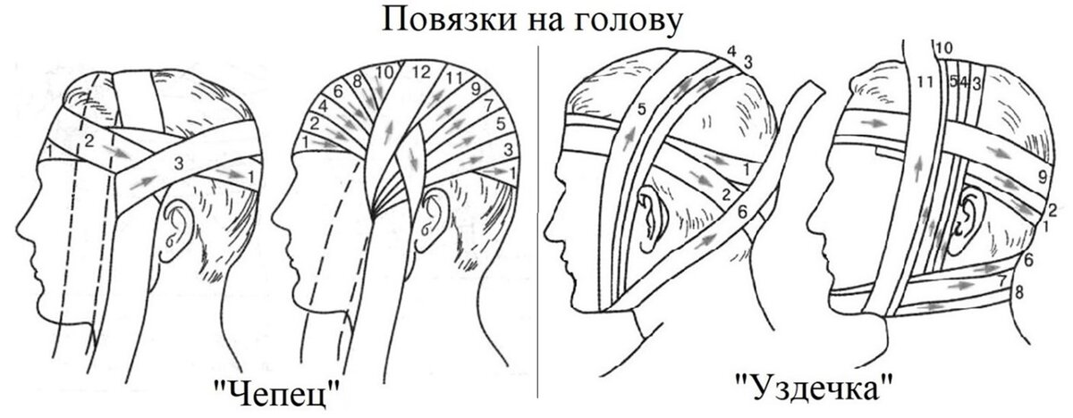 Наложение повязки уздечка алгоритм. Повязка уздечка техника наложения. Техника уздечка. Бинтовая повязка уздечка. Повязка уздечка десмургия.