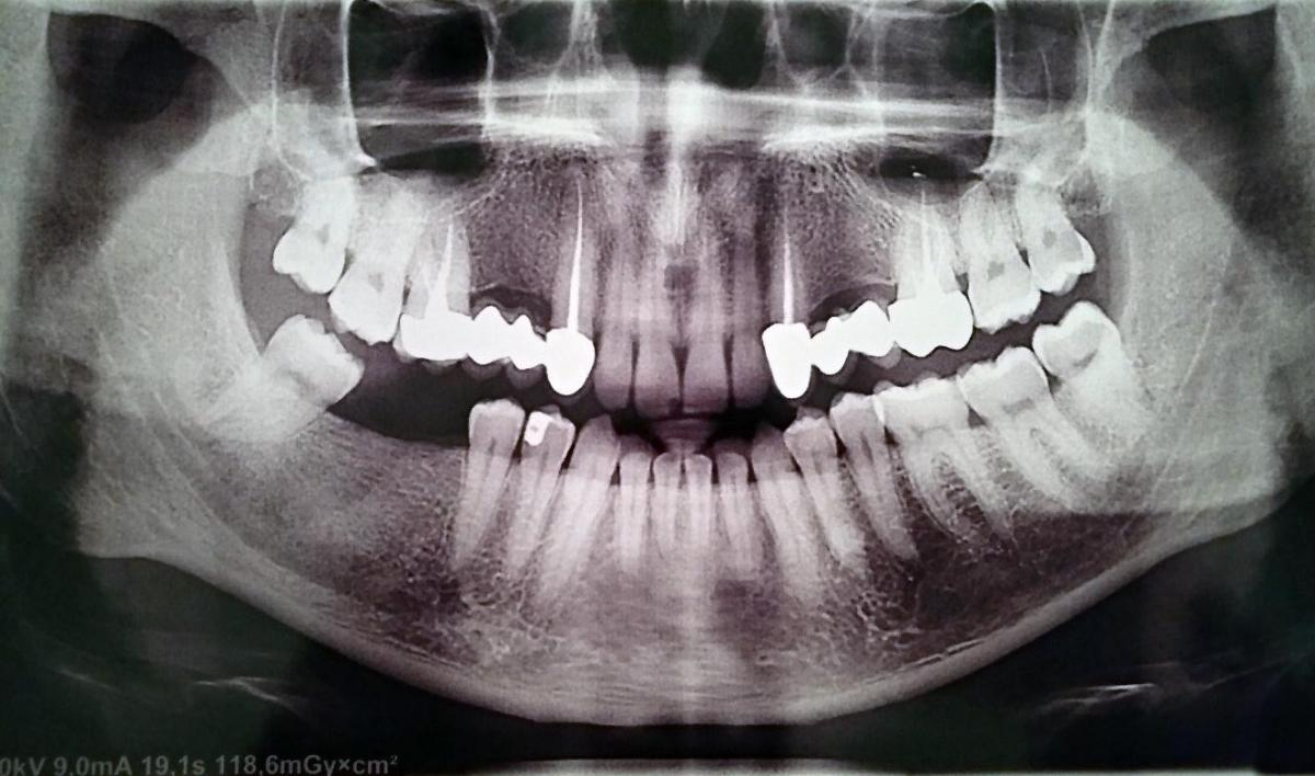 Без снимка. Рентген ортопантомограмма зубов. Рентгенография ОПТГ зубных рядов. ОПТГ зубных рядов Пикассо. Пикассо ортопантомограмма.