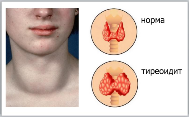 Аутоиммунный тиреоидит щитовидной железы (АИТ)
