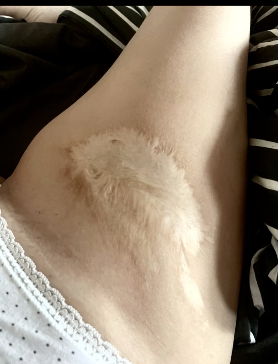 Ожоговый шрам