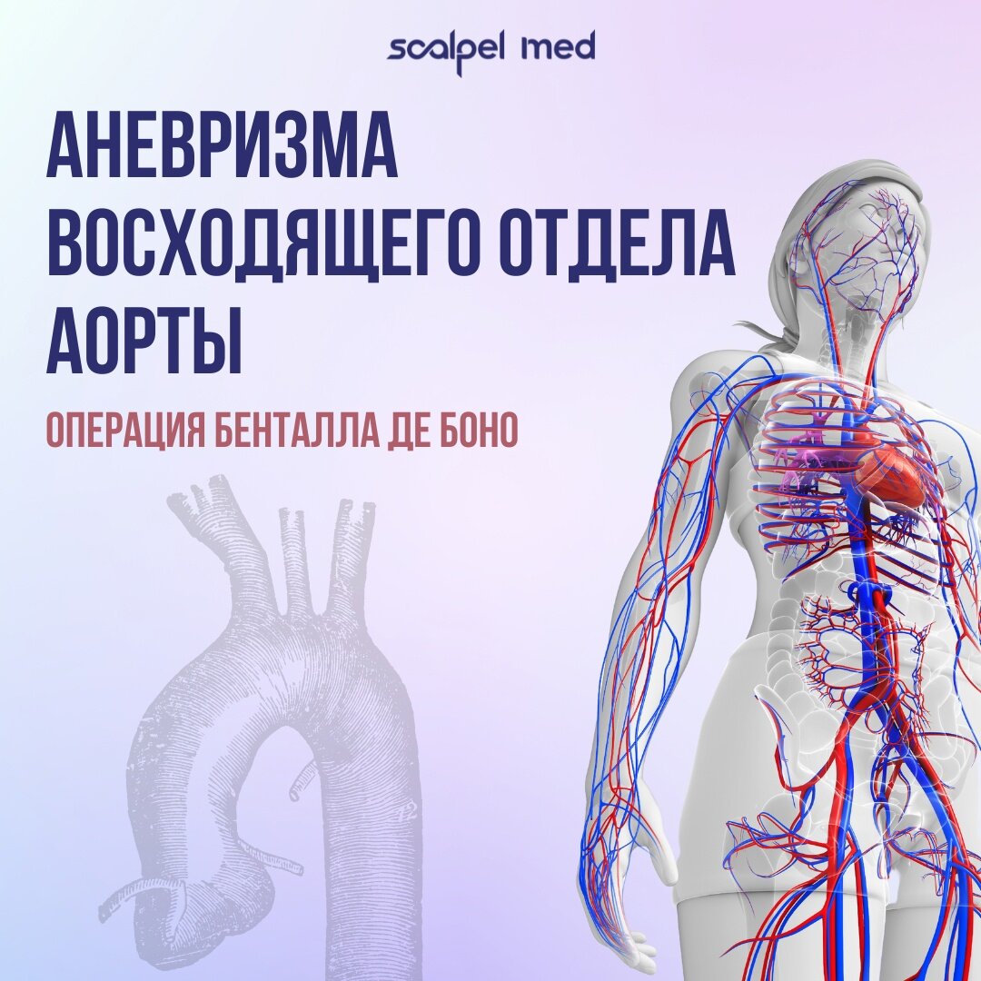 Аневризма восходящего отдела аорты