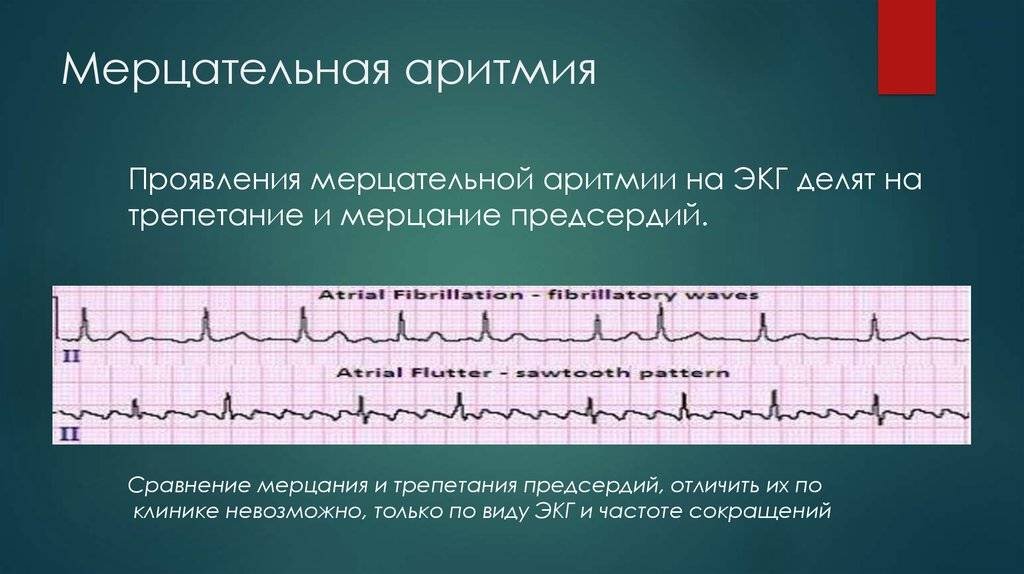 ⚕ Мерцательная аритмия ➡【Симптомы и лечение в Киеве】