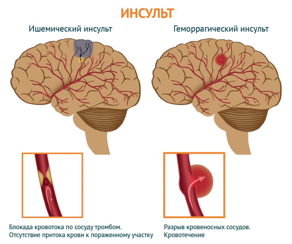 Обширный инсульт