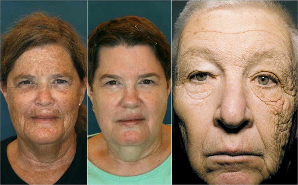 Примеры фотостарения. Близнецы Бетта и Бриджет. Одна жила в солнечном Канзасе, а вторая в Канаде. И фото дальнобойщика которому 30 лет солнце светило с одной стороны. 