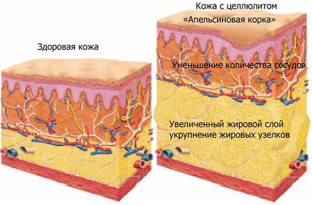 Целлюлит на животе — эстетическая проблема, с которой сталкиваются женщины в разном возрасте независимо от телосложения.-2