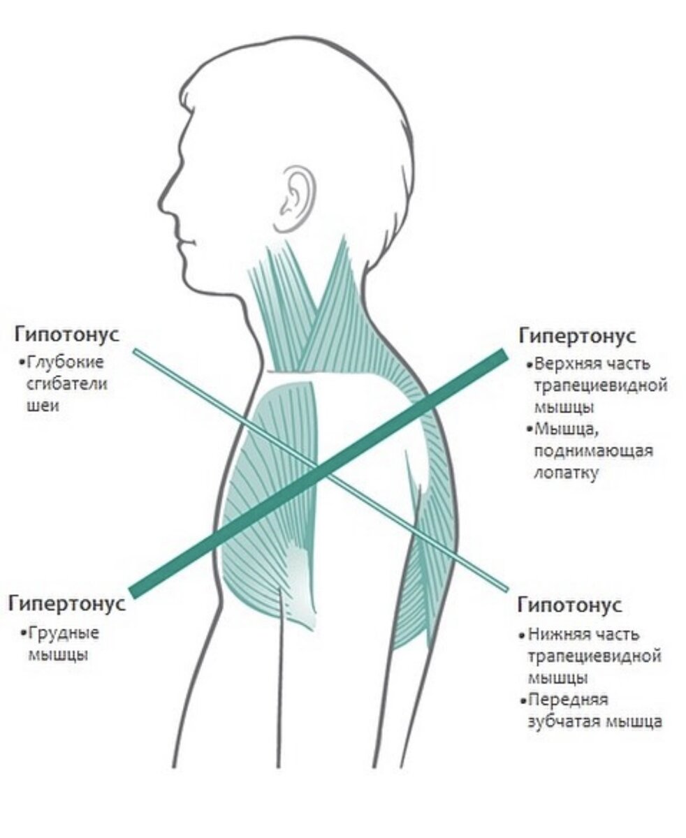 Разрыв мышцы