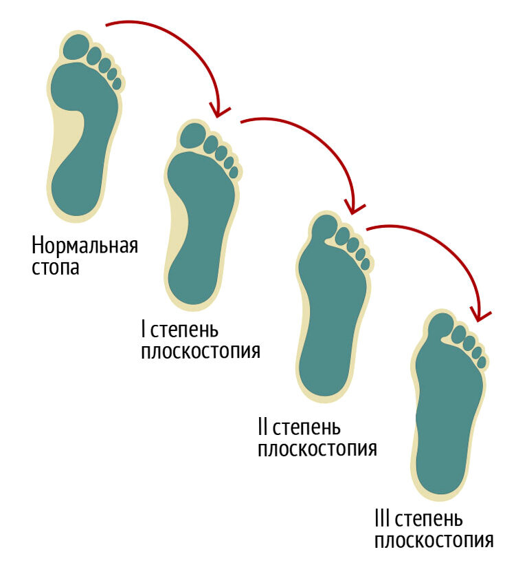 Плоскостопие вид сбоку. Поперечное III - IV степени плоскостопие. Плантография 3 степень плоскостопия. Как определить плоскостопие 1 степени у взрослого.