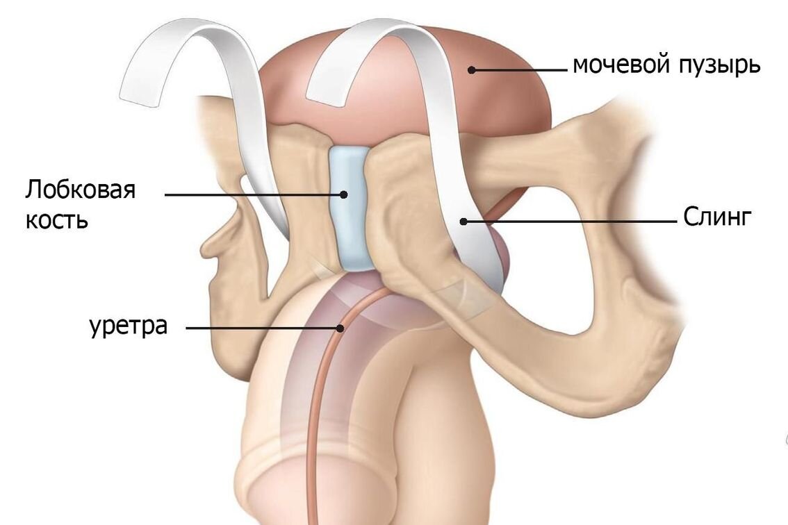 Недержание мочи - не приговор! Искусственный сфинктер мочевого пузыря. |  Центр генитальной хирургии и андрологии | Дзен