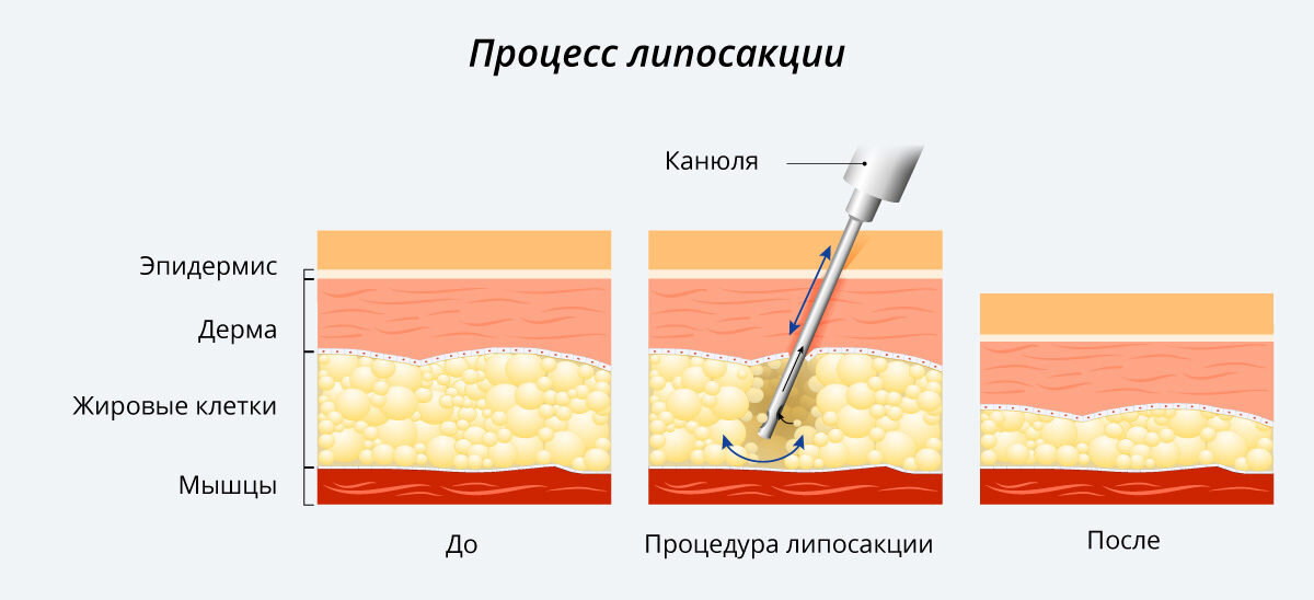 Процесс Липосакция