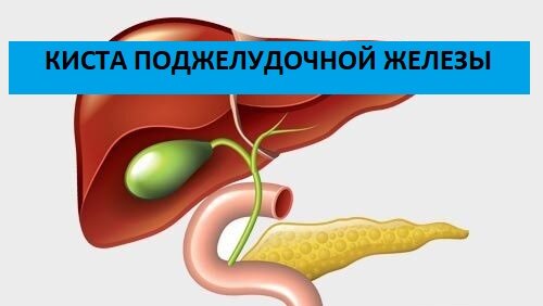 Причины кист поджелудочной железы. Реактивные изменения поджелудочной железы. Разжижение желчи в желчном. Киста поджелудочной железы.