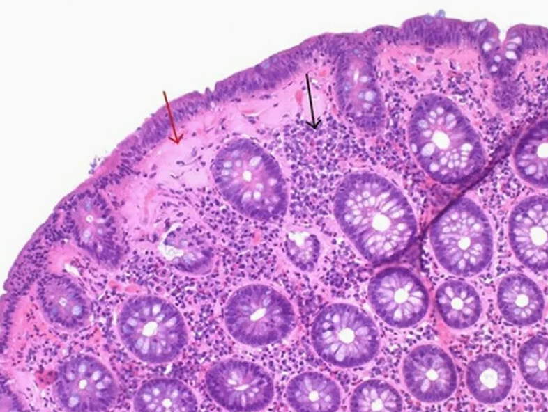Хронический энтерит гистология. Микроскопический колит гистология. Лимфоцитарный энтерит гистология. Микроскопический коллагенозный колит. Колит гистология.