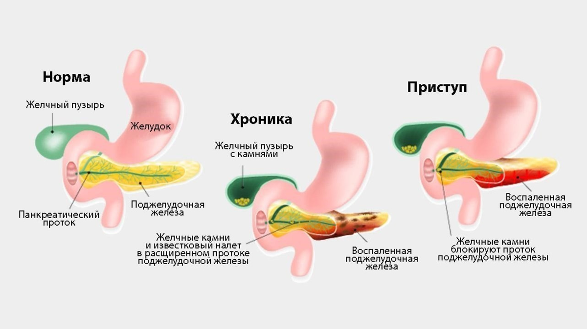 Панкреатит где болит. Поджелудочная железа симптомы. Острый идиопатический панкреатит. Панкреатит симптомы у мужчин.