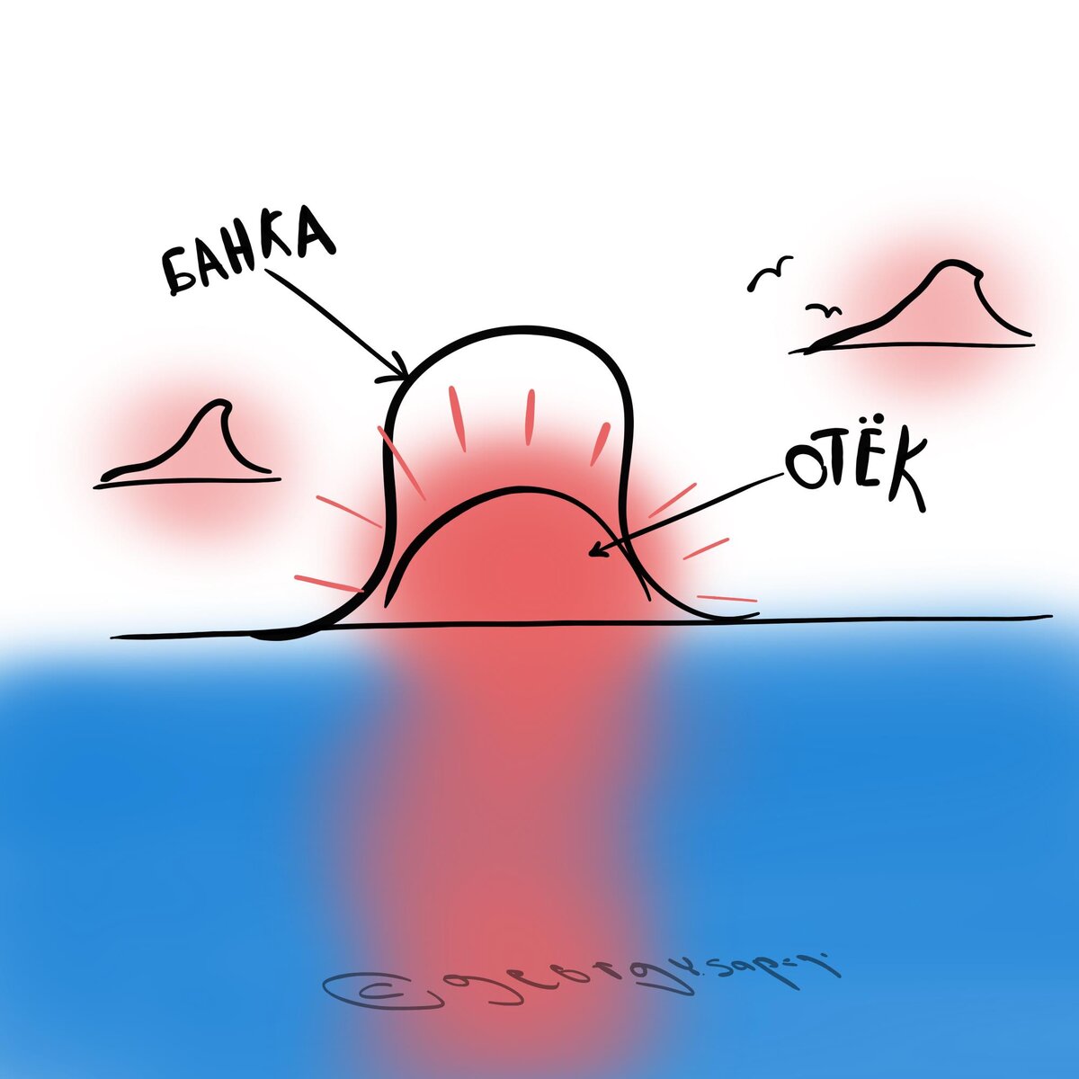 Банка делает отёк