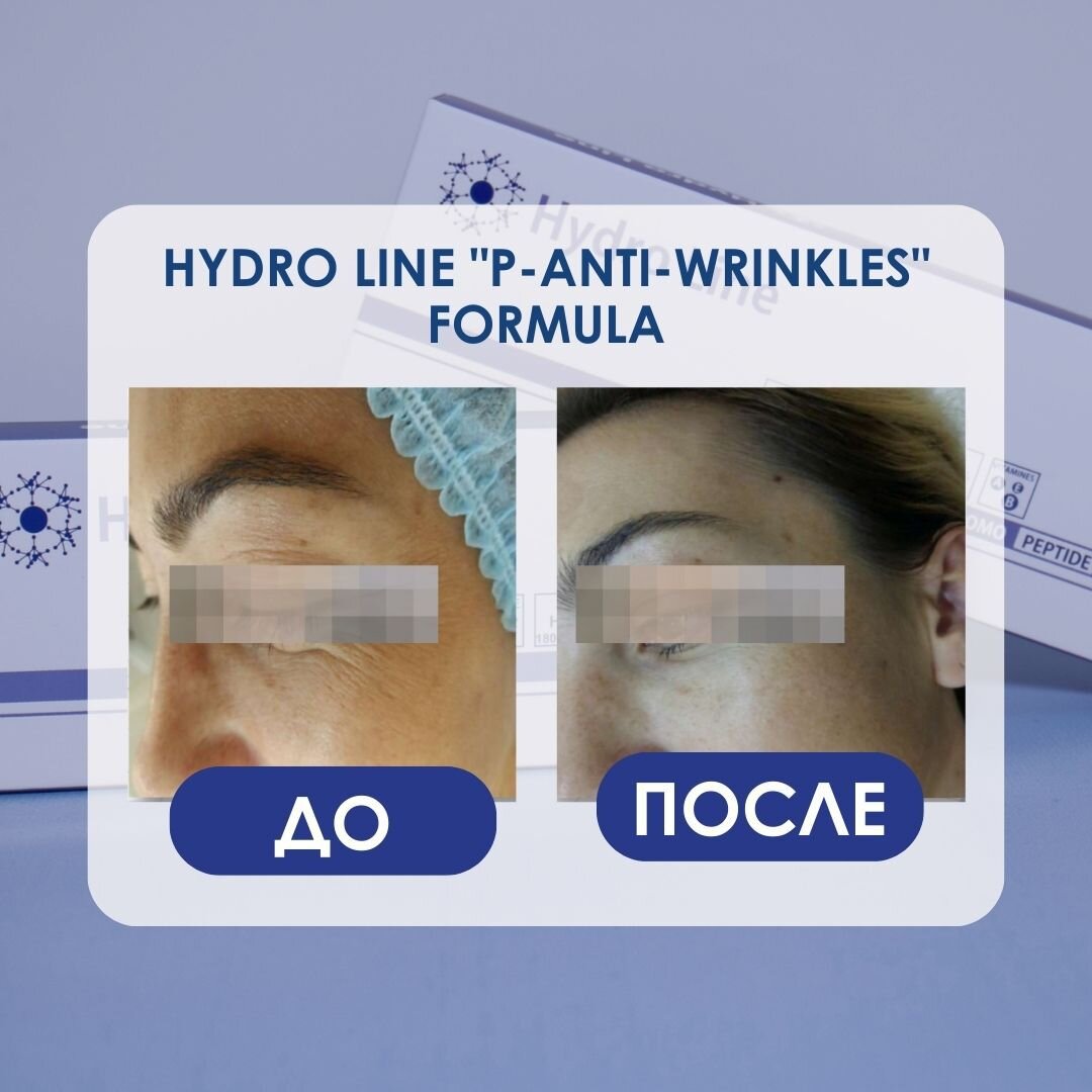 Hydro line. Hydro line p-Anti-Wrinkles. Hydro line Мезофарм. Крем от морщин до и после. Лучшее от морщин.