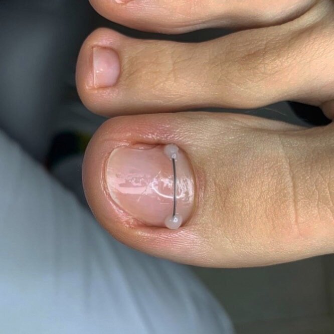 Лечение дистрофии ногтя