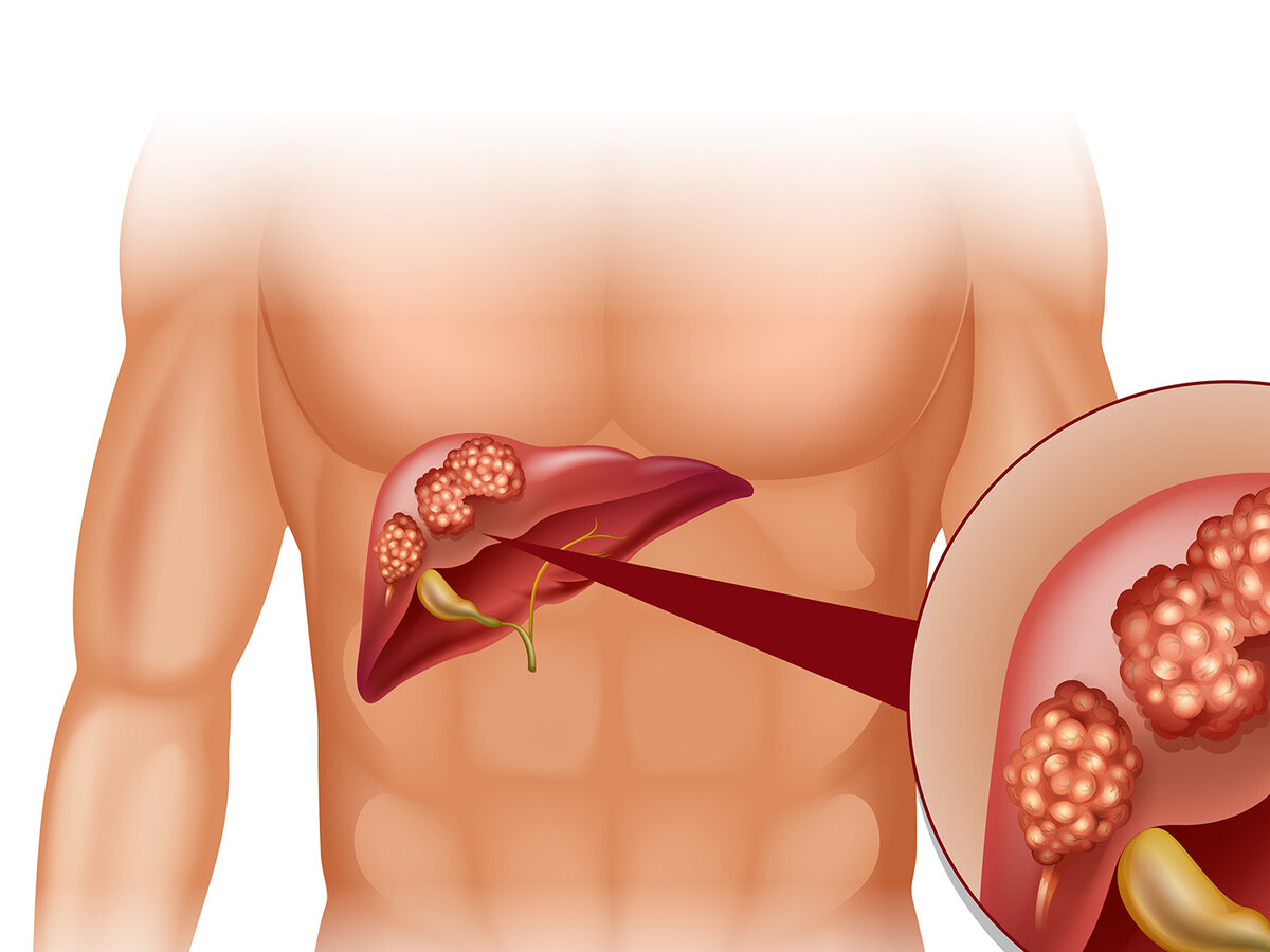 Рак печени симптомы