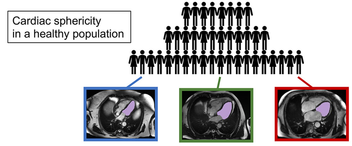     По МРТ изображению можно разделить сердца с нормальной формой левого желудочка — в центре, продолговатой — слева и сферической — справа Milos Vukadinovic et. al / Med, 2023