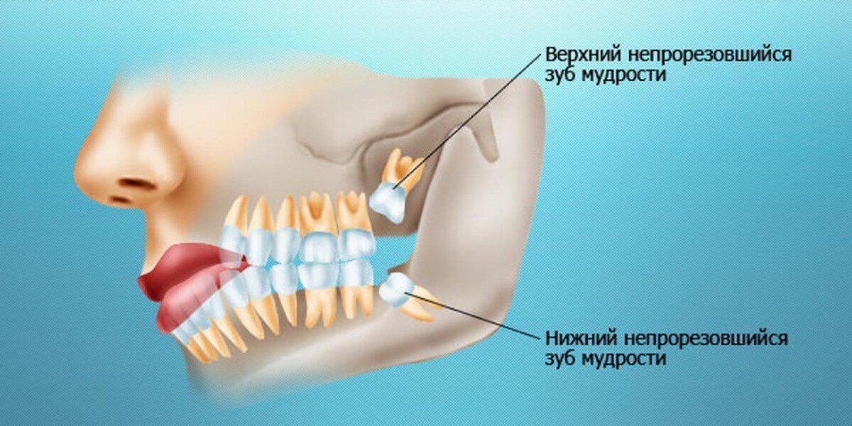 Лечение зуба 8